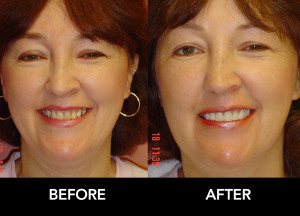 Bridgework-Crowns-Restore-Smile-before-after