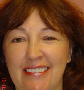 Bridgework/ Crowns Restore Smile