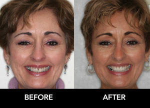 Crown-Fixes-Spaces-before-after