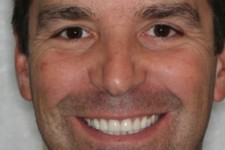 Veneer/Whitening For A Perfect Smile