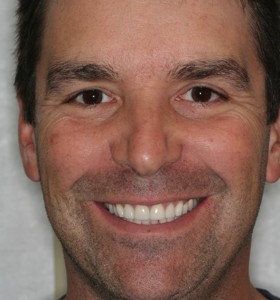 Veneer/Whitening For A Perfect Smile