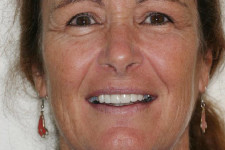 Crownwork Creates a Nice Smile