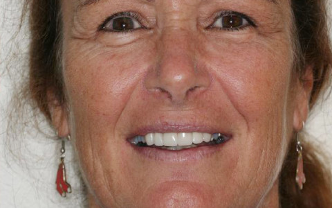 Crownwork Creates a Nice Smile