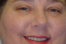 Crownwork Makes Straight, White Teeth