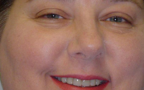 Crownwork Makes Straight, White Teeth