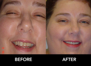 Crownwork-Make-Straight-before-after