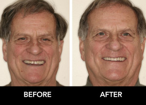 Extensive-Restorative-Dentistry-before-after