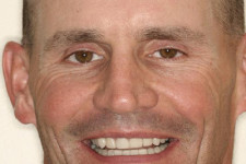 Full-Mouth Reconstruction