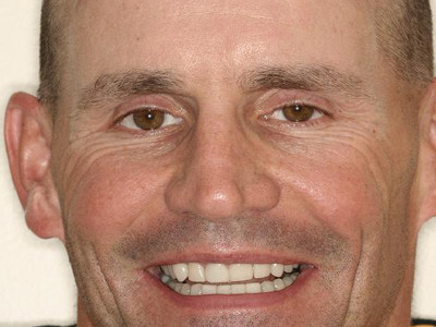 Full-Mouth Reconstruction