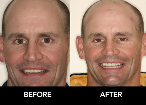 Full-Mouth-Reconstruction-t-before-after