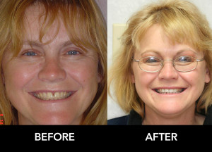 Kim-Ideal-Teeth-Shape-after-before-after