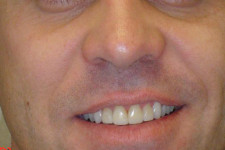 Anterior Crownwork Completed to Improve Shape of Teeth