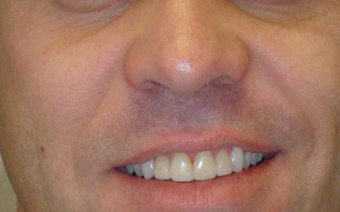 Anterior Crownwork Completed to Improve Shape of Teeth