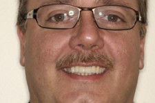 Replaced Anterior Bridge – Better Look & Fit