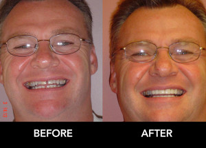 Rick-Crowns-Veneers-Fixes-Spaces