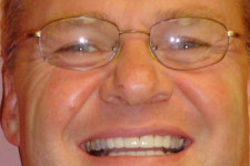 Crowns/Veneers Fixes Spaces