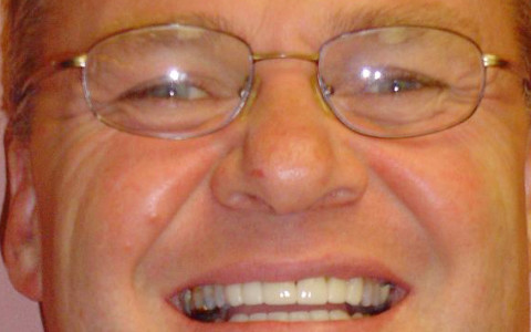 Crowns/Veneers Fixes Spaces