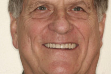 Extensive Restorative Dentistry