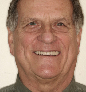 Extensive Restorative Dentistry