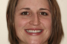 Veneered Anterior Teeth