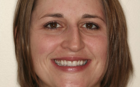 Veneered Anterior Teeth