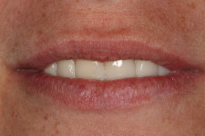 Whitening/Veneers/Crownwork – Results Amazing!