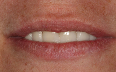 Whitening/Veneers/Crownwork – Results Amazing!