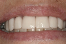 Rounder, Whiter, Straighter Teeth