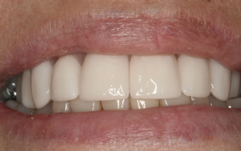 Rounder, Whiter, Straighter Teeth