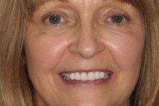 Whiter Esthetically Pleasing Teeth