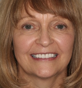 Whiter Esthetically Pleasing Teeth