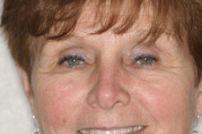 Whitening and Crowns Improve Smile