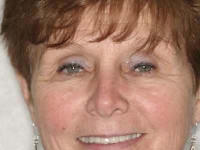 Whitening and Crowns Improve Smile