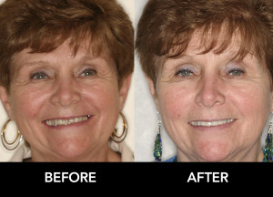 whittening-crowns-improve-Smile-before-after