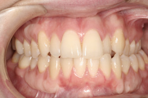 Invisaline- Before-Amy