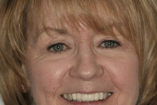 Beautiful Smile with Crownwork