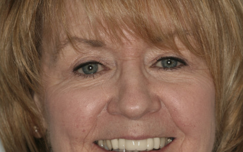 Beautiful Smile with Crownwork