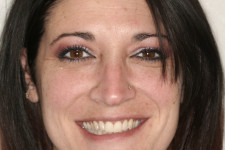 Beautiful Straight Teeth with Invisalign