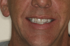 Whitening and Composite Bonding