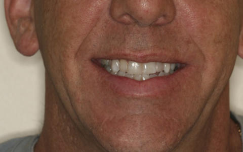 Whitening and Composite Bonding