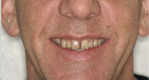 before- Whitening-Composite- Bonding-1