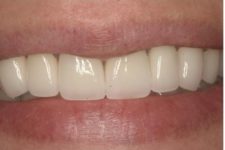 Confident Smile with Crowns