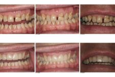 Upper Anterior Teeth Fixed