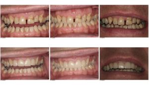 Upper- Anterior-Teeth-Fixed