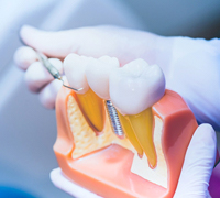 dentist in Worcester pointing to a model of an implant-retained crown