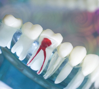 Model of tooth that needs root canal therapy in Worcester