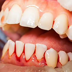 Closeup of what gum disease in Worcester looks like